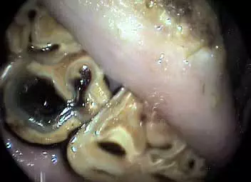 Ouverture d'une cavité pulpaire sur une dent inférieure cavité pulpaire