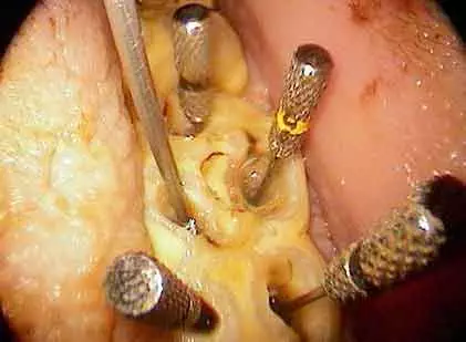 Pulpectomie (dévitalisation) sur une polaire Dévitalisation